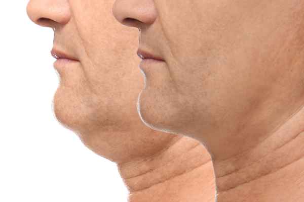 HIFU - Breakthrough in Anti - ageing 2 hifu results Southampton