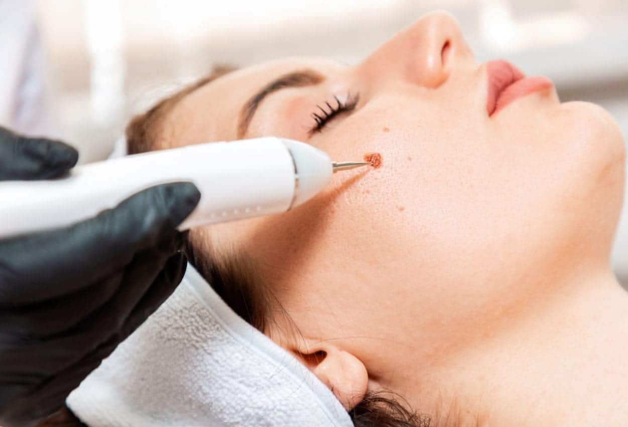 Benefits of Ephelides Treatment Southampton 	