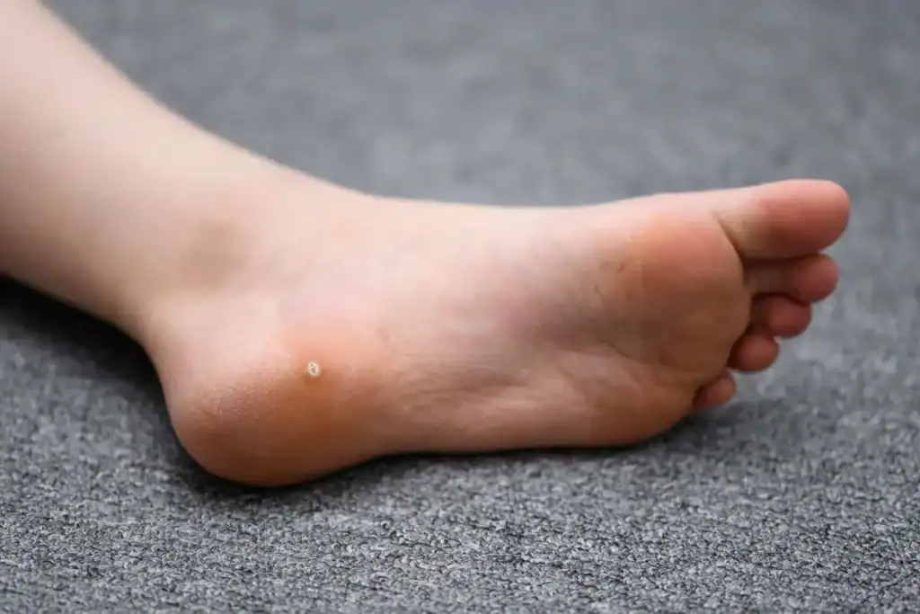 Cryotherapy For Warts And Also Verrucas 2 Image of verruca on the bottom of the foot that able to be treated with Cryotherapy Southampton
