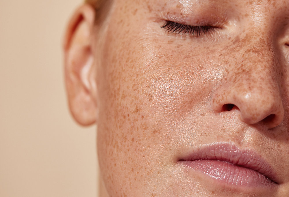 Why Is Lipo 360 Southampton 	 the Right Place for Ephelides Treatment?