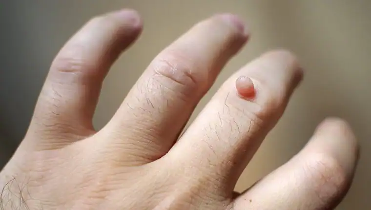 Cryotherapy For Warts And Also Verrucas 1 Image of blemish that Cryotherapy Southampton can remove with Lipo 360.
