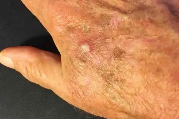Cryopen For Actinic Keratoses 1 Image of Actinic keratoses Southampton on a person hand
