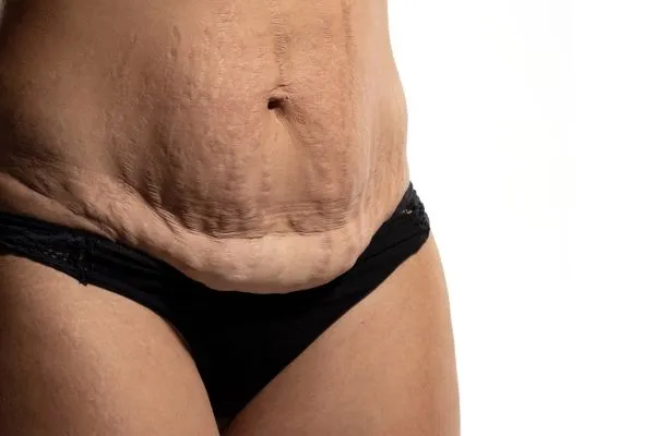The Science of Skin Tightening 1 The science behind skin tightening Southampton picture of a woman's sagging skin on the stomach