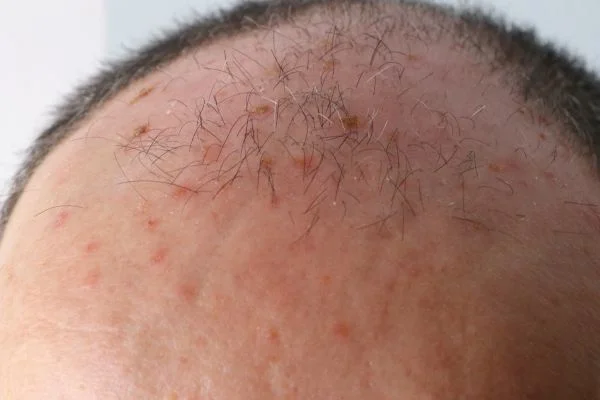 Actinic Keratoses Southampton 	