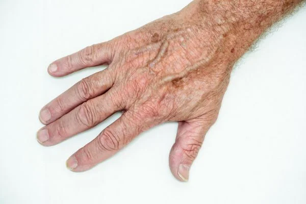 age spot removal Southampton 	