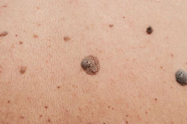 Benign Moles Southampton 	