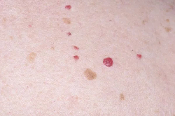Cherry Angiomas Southampton 	