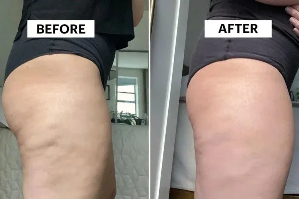 Body Sculpting Results Southampton 	