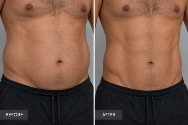 Body sculpting results Southampton 	