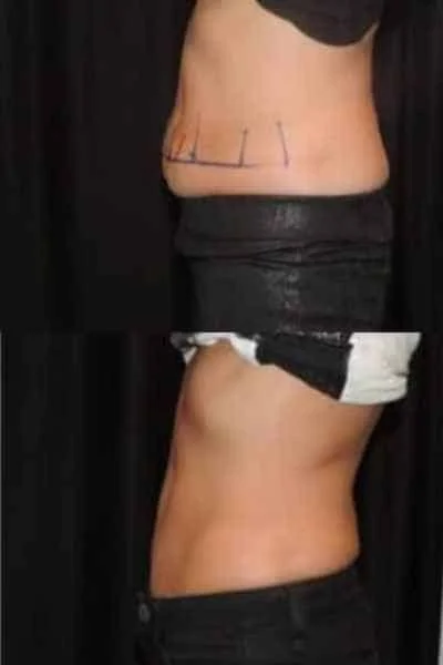 Before and after results for fat freezing woman's stomach