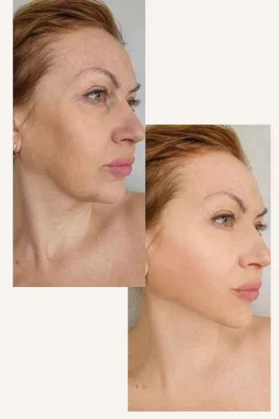 HIFU Results Southampton 	 before and after