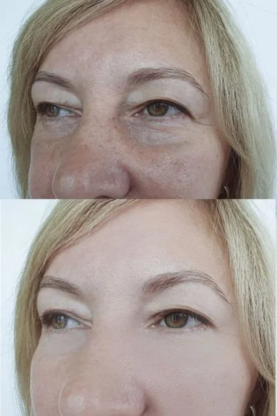 collagen lift 360 results Southampton 	