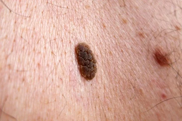 Seborrhoeic Keratoses removal Southampton 	