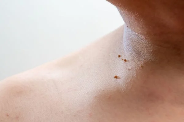skin tag removal Southampton 	